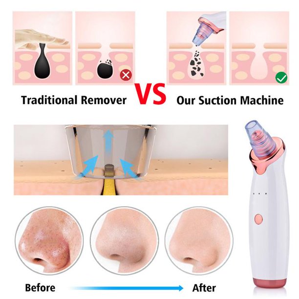 N1 Electric Blackhead Remover Pore Vacuum Suction Dermabrasion Face Cleaner - Image 7